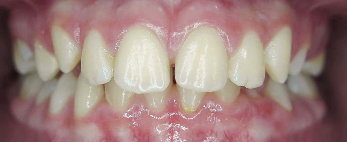 Przed leczeniem ortodontycznym, przypadek 1